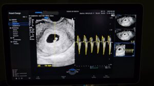 Read more about the article 임신 5~8주차 간단 기록