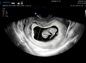 Read more about the article 임신 9~11주차 간단 기록